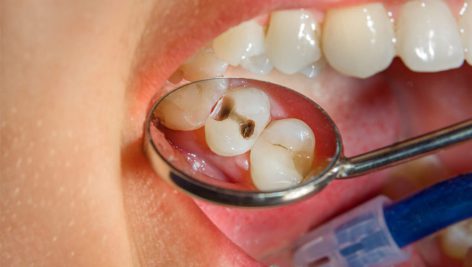 تحقیق در مورد کربوهیدرات ها و پوسیدگی دندان